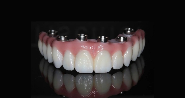 full-mouth-rehabilation-with-implants