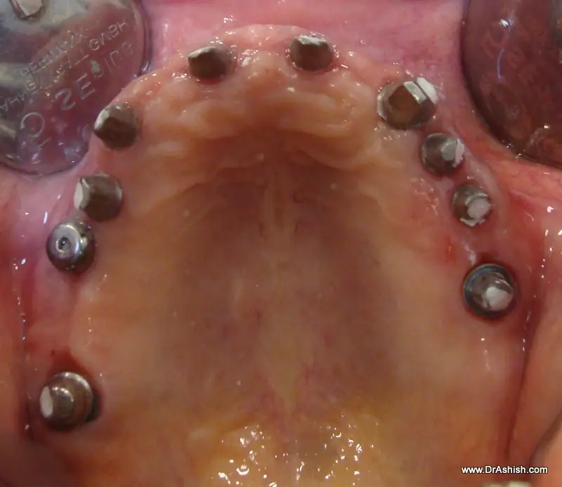 full-mouth-rehabilitation-using-implants-img1