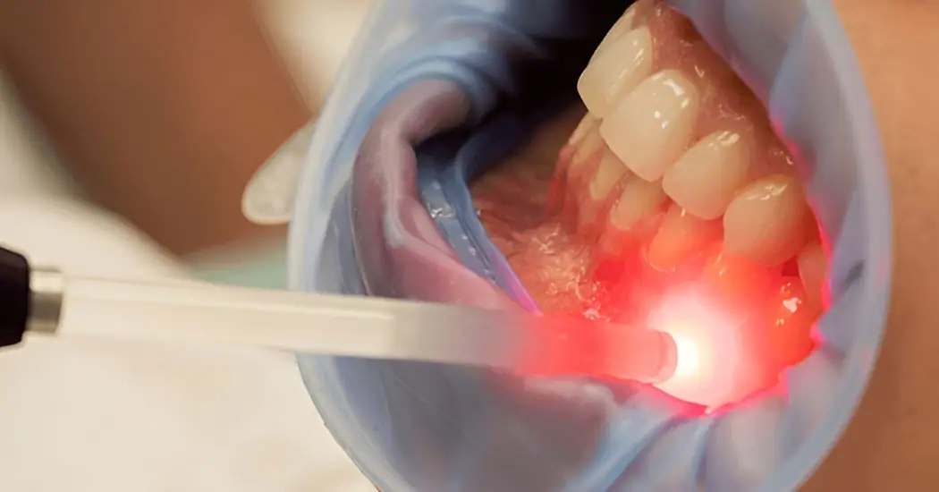 laser-treatment-1